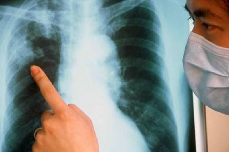 В тюменской больнице используют новую методику диагностики туберкулеза